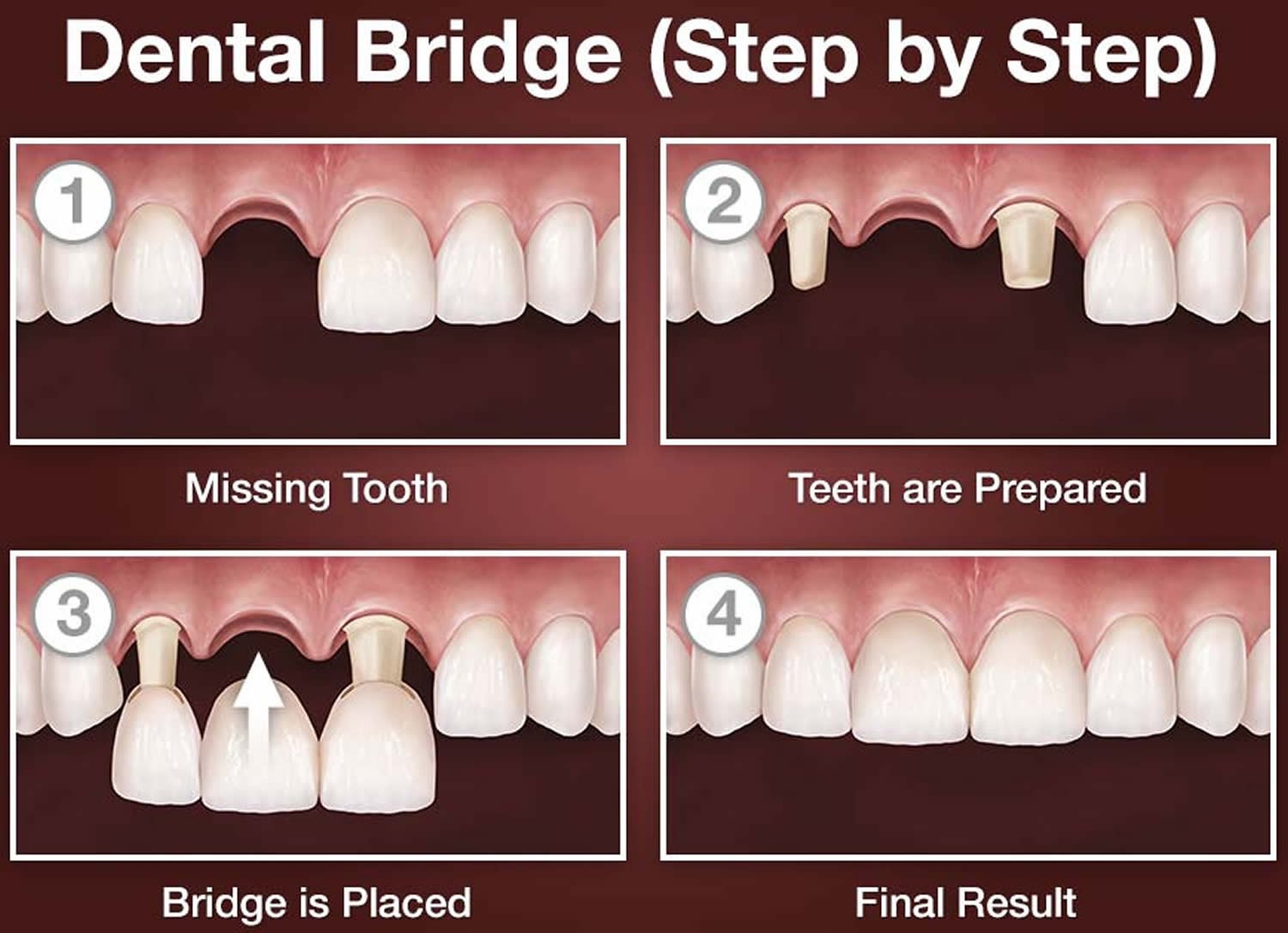 The Ultimate Guide: How Long Does It Take To Get A Dental Bridge