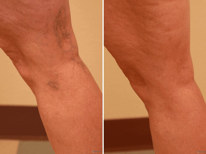 Exploring The Duration: How Long Does Sclerotherapy Last