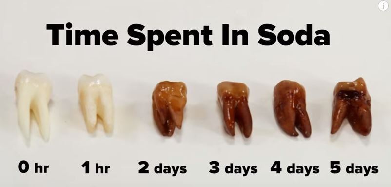 When Can I Drink Soda After Wisdom Teeth Removal?