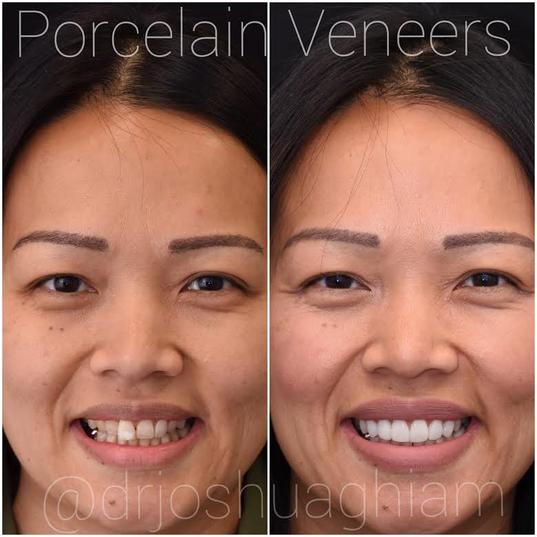 Cost Of Veneers In California: How Much Are Veneers In California