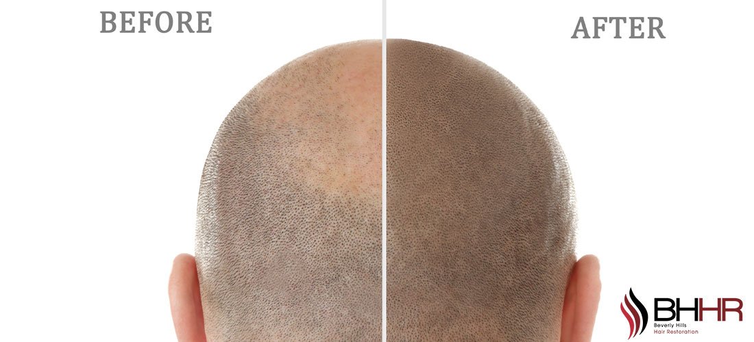 Cost Of Micropigmentation: How Much Does Micropigmentation Cost?