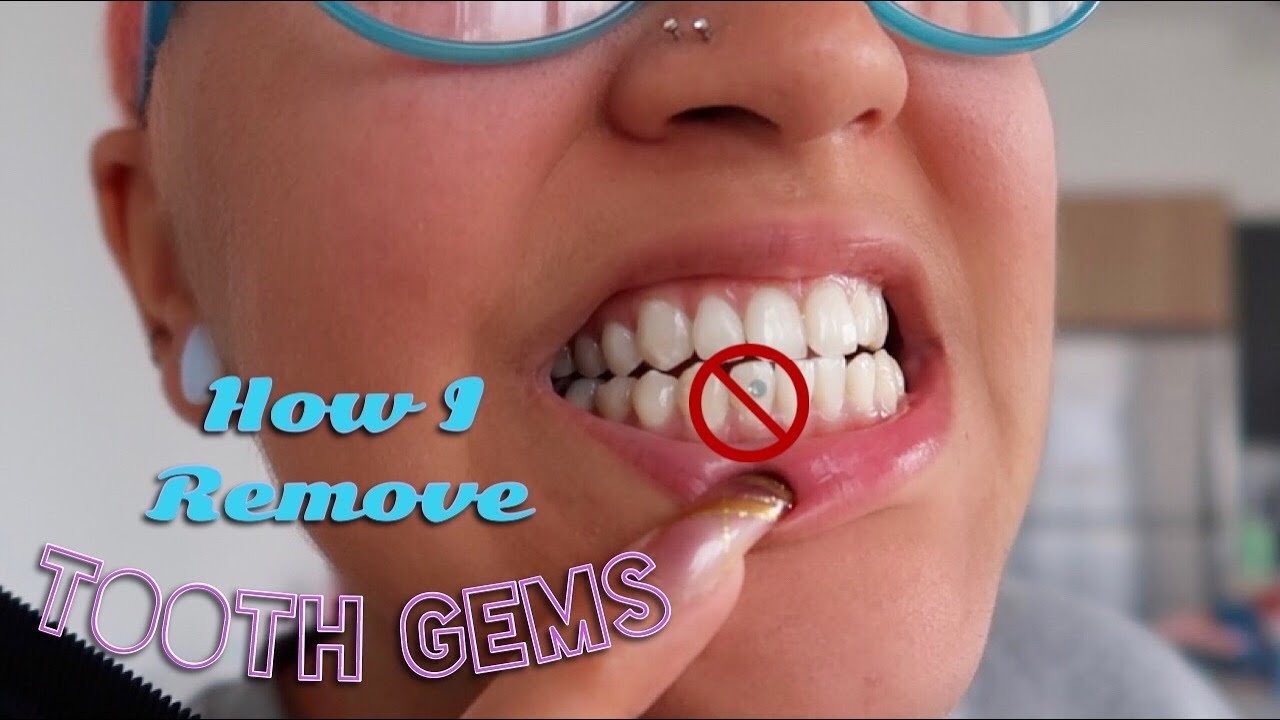 Remove Tooth Gems: How To Take Tooth Gems Off Efficently
